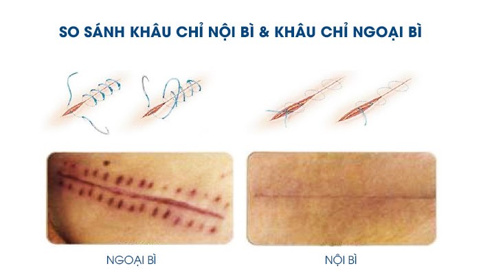 Cách khâu giấu chỉ phẫu thuật